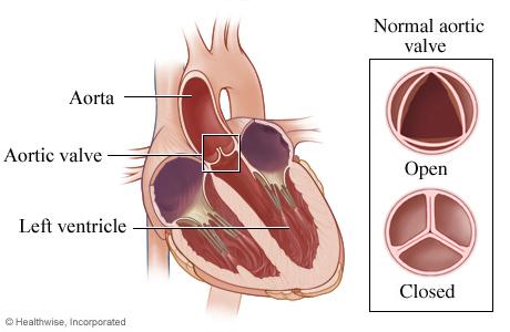 Aortic Valve Disease Frankel Cardiovascular Center Michigan